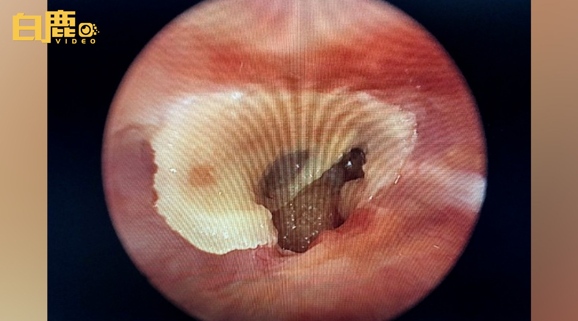 男子误用502滴耳半年后鼓膜穿孔耳朵持续流脓才就医 - 虎扑社区