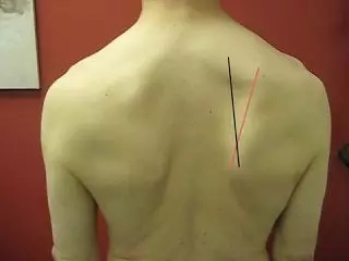 肩胛骨不正 颈肩痛难康复zt 虎扑