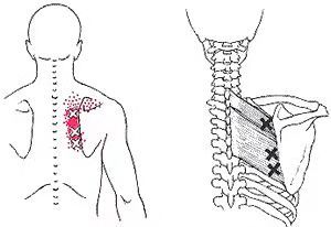肩胛骨不正 颈肩痛难康复zt 虎扑